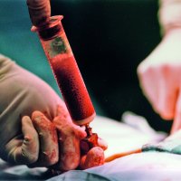 Hlavní obrázek - Studie MESEMS: u transplantace kmenových buněk při RS se zatím prokázala jen bezpečnost